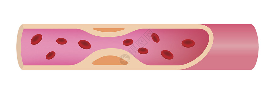 动脉硬化晚期它制作图案图片