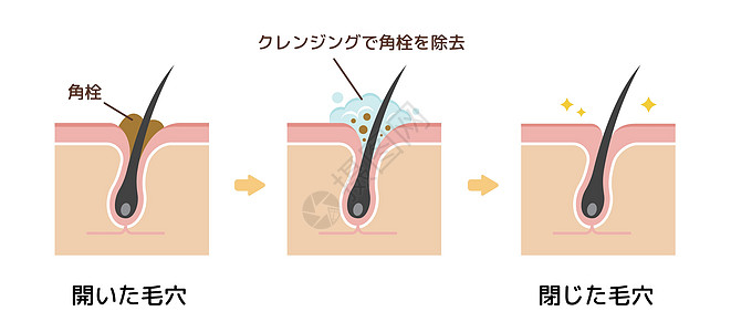 毛孔结构示意图 清除角质栓塞白头 清洁后的黑头表皮化妆品治疗擦洗卡通片插图载体头发细胞气泡图片