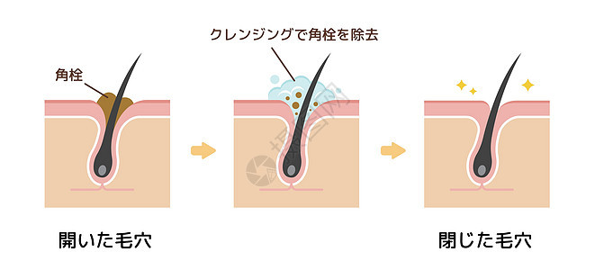 毛孔结构示意图 清除角质栓塞白头 清洁后的黑头表皮化妆品治疗擦洗卡通片插图载体头发细胞气泡图片