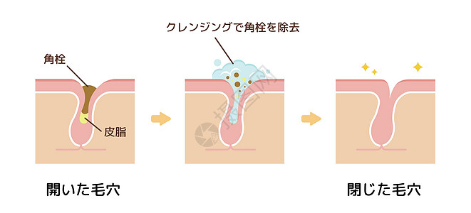 毛孔结构示意图 清除角质栓塞白头 清洁后的黑头气泡皮肤科打扫组织皮肤载体擦洗粉刺化妆品表皮图片