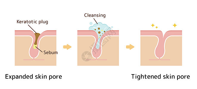 毛孔结构示意图 清除角质栓塞白头 清洁后的黑头擦洗插图头发皮肤科皮肤粉刺细胞治疗图表化妆品图片