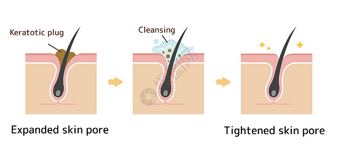 毛孔结构示意图 清除角质栓塞白头 清洁后的黑头细胞擦洗组织治疗表皮图表洁面头发载体解剖学图片