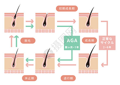 正常毛发周期与AGA雄激素性脱发的对比图脱发头发乳突载体生长解剖学雄激素生长期沙龙休止期图片