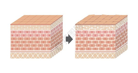 皮肤剖面图 健康皮肤与受伤滑雪者保护效果对比图商业障碍损害真皮学校细菌图表药品解剖学信息图片