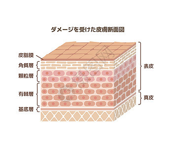 它制作图案损坏的皮肤层药品治疗插图卫生护理障碍皮脂表皮身体角质层图片