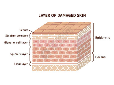 它制作图案损坏的皮肤层保健表皮障碍皮脂插图细胞护理卫生药品身体图片