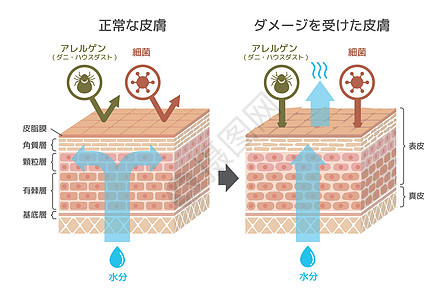 皮肤剖面图 健康皮肤与受伤滑雪者保护效果对比图皮脂治疗横截面信息细胞学校水分绘画过敏身体图片