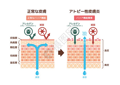 特应性皮炎和正常皮肤比较的截面图瘙痒湿疹治疗疾病插图身体皮炎解剖学损害医生图片