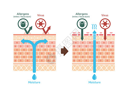特应性皮炎和正常皮肤比较的截面图疾病症状药品表皮护理湿疹保健身体疼痛插图图片