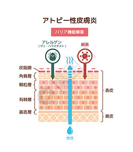 特应性皮炎载体它制作图案的剖面图皮炎解剖学护理插图卫生过敏瘙痒损害保健医生图片