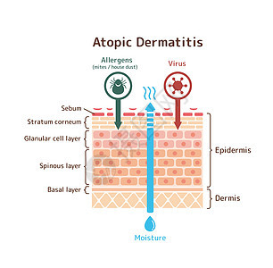 特应性皮炎载体它制作图案的剖面图瘙痒疾病皮肤剥皮症状卫生身体皮炎插图湿疹图片