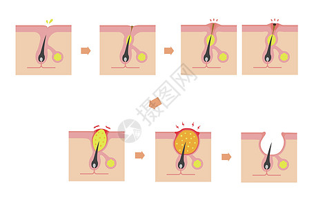 Acne类型和递进说明毛孔载体真皮皮脂白头卵泡生物学细胞痤疮图表图片