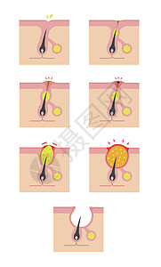Acne类型和递进说明编队生物学粉刺皮脂护理皮肤载体头发疙瘩卵泡图片