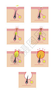 Acne类型和递进说明编队生物学粉刺皮脂护理皮肤载体头发疙瘩卵泡图片