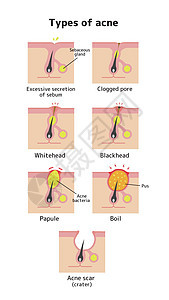 Acne类型和递进说明毛孔陨石疙瘩编队疤痕图表生物学治疗皮肤载体图片