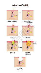 Acne类型和递进说明卵泡痤疮疾病头发女士陨石皮脂身体生物学护理图片