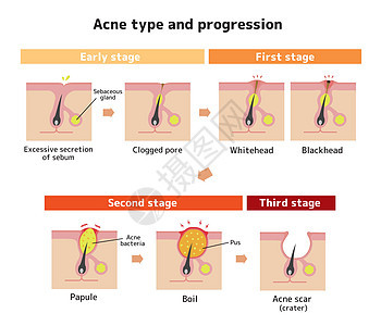 Acne类型和递进说明皮肤编队治疗真皮生物学细胞皮脂腺身体白头插图图片