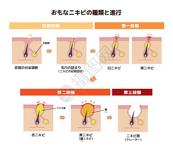 Acne类型和递进说明皮脂白头细菌卵泡图表疾病粉刺毛孔疙瘩插图图片