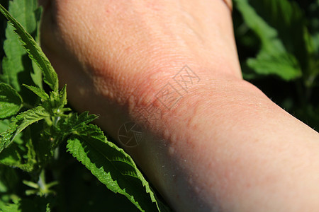 刺痛的和有刺痛的手部绿色茶厂烧伤花草头发草本植物荨麻植物群植物生长图片