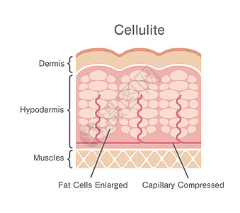 脂肪团皮肤它制作图案组织身体图表绘画插图饮食护理真皮卫生编队图片