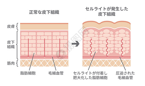 正常皮肤和橘皮组织滑雪的比较图保健绘画治疗插图脂肪生物学表皮图表真皮身体图片