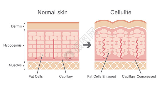 正常皮肤和橘皮组织滑雪的比较图身体女性解剖学编队表皮护理图表细胞饮食卫生图片