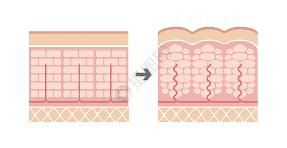 正常皮肤和橘皮组织滑雪的比较图饮食脂肪绘画身体表皮胶原插图保健图表卫生图片