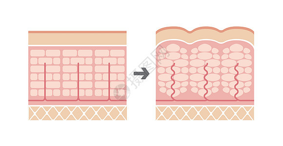 正常皮肤和橘皮组织滑雪的比较图饮食脂肪绘画身体表皮胶原插图保健图表卫生图片