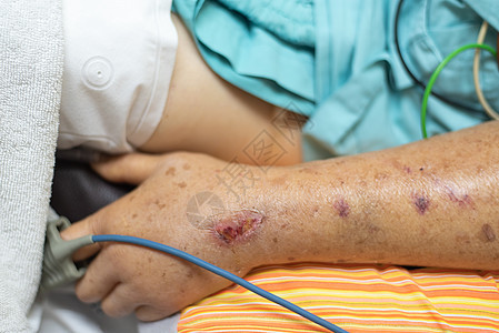 住院病人 手指有脉搏测量仪病房高血压同情盐水医师帮助疾病压力癌症护士图片