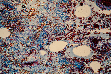 显微镜下的肺组织 200x红色蓝色科学组织学感染病菌流感诊断瘟疫筷子图片