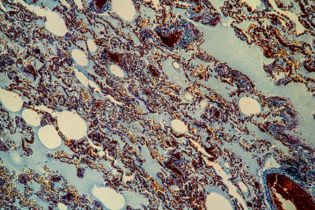显微镜下的肺组织 200x感染红色科学筷子蓝色组织学瘟疫诊断病理流感图片