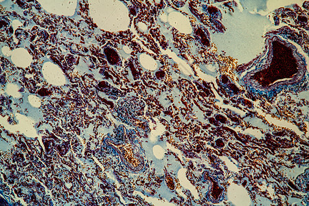 显微镜下的肺组织 200x诊断病理瘟疫流感病菌感染蓝色筷子红色科学图片