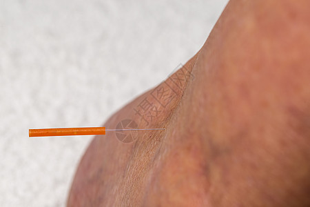 腿上助产针刺治疗艾灸治愈者疗法皮肤医疗自然康复药品中医加热图片