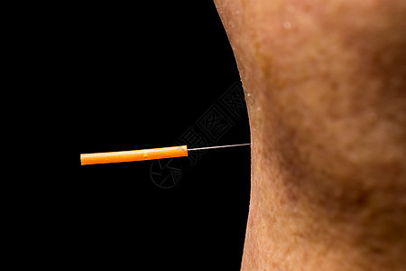 腿上助产针刺治疗加热疗法皮肤中医康复治愈者自然医疗药品艾灸图片