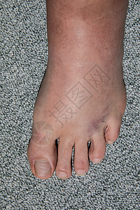 弯曲后左脚严重肿胀和血肿疼痛扭伤拉伸损伤韧带运动脚趾皮肤图片