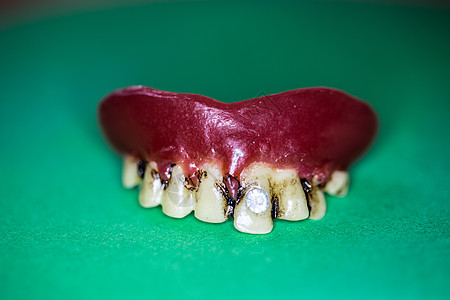 上下巴假牙的假牙下颌牙印植入物部分牙科门牙修复术假肢治疗牙医图片