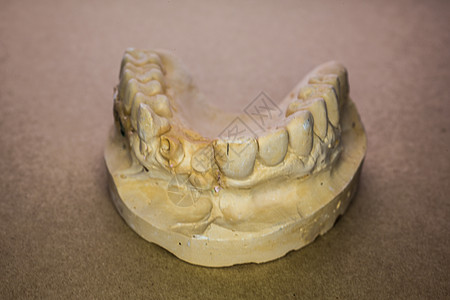 奥贝基费尔Abdruck假牙牙科治疗下颌假肢植入物门牙牙列牙印维修图片