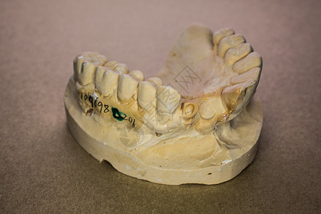 奥贝基费尔Abdruck臼齿上颚维修牙科门牙牙医治疗修复术牙印假肢图片