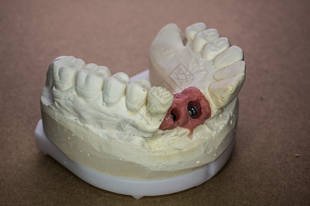 假印花牙齿植入物假牙臼齿上颚牙医牙科治疗维修门牙图片