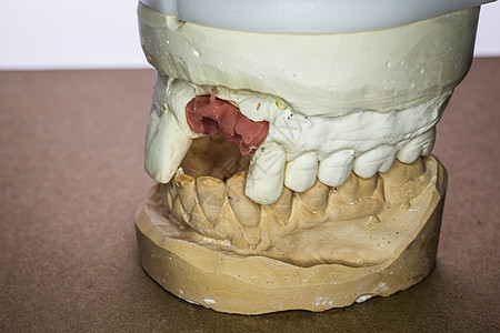 假印花牙印下颌牙齿牙医修复术治疗臼齿部分牙列门牙图片