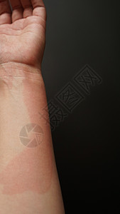女性手被红色斑点覆盖 贴近伤口 过敏反应皮疹女士症状皮肤疾病皮炎身体过敏女孩药品图片