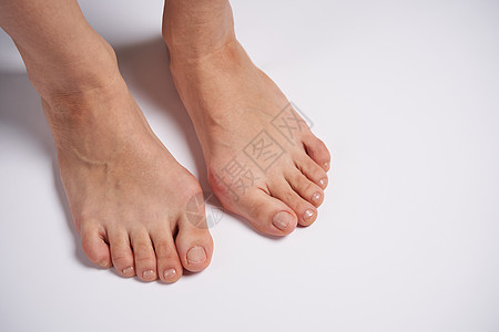 女性双腿上的紧贴在白色背景上畸形外翻治疗状况手指病人保健疼痛骨科疾病图片