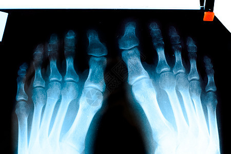 脚印X光 骨头研究临床解剖学辐射治疗器官生物学诊所诊断快照情况图片