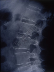 用于医学诊断的脊椎X光图像椎体射线扫描x光骨骼骨架脊髓考试药品医生图片