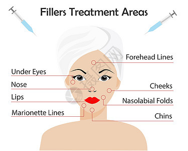 妇女面对皮肤填充器肉毒杆菌注射治疗区插图商业塑料卫生美学皱纹诊所脸颊病人线条图片