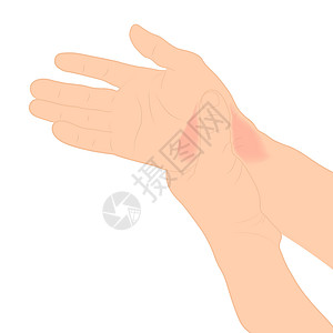 手腕疼痛 男人握着她的手腕疼痛 因为手腕区域有韧带 病媒图解概念疾病和保健控制注射药品手臂关节前臂茎突诊所插图成人图片