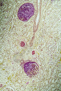 携带真菌Candida生长100x的艾滋病组织宏观科学缺陷康复治愈免疫组织学疾病药品检查图片