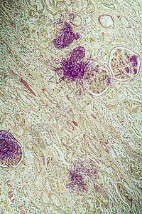 携带真菌Candida生长100x的艾滋病组织药品检查治愈康复缺陷组织学病理疾病科学调查图片