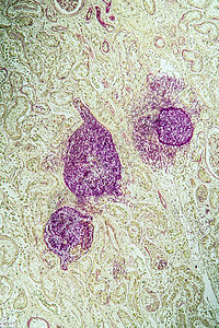 携带真菌Candida生长100x的艾滋病组织检查免疫治愈组织学缺陷科学康复宏观诊断调查图片