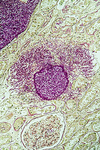 携带真菌Candida生长200x的艾滋病组织组织学治愈病理缺陷科学检查诊断宏观调查疾病图片